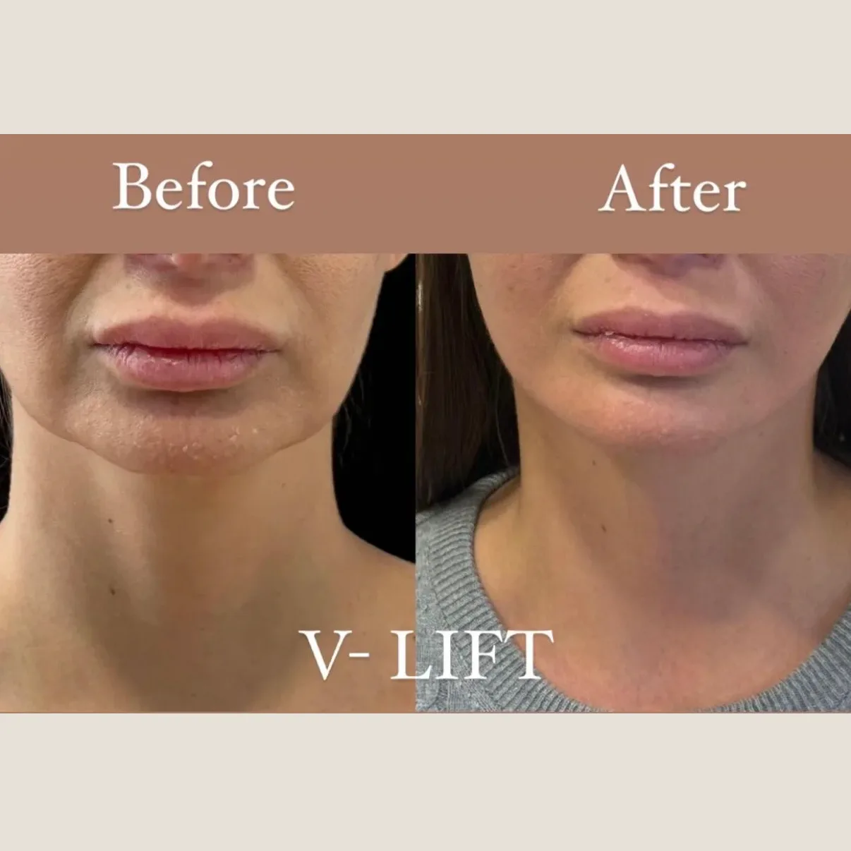 VLift-BA01