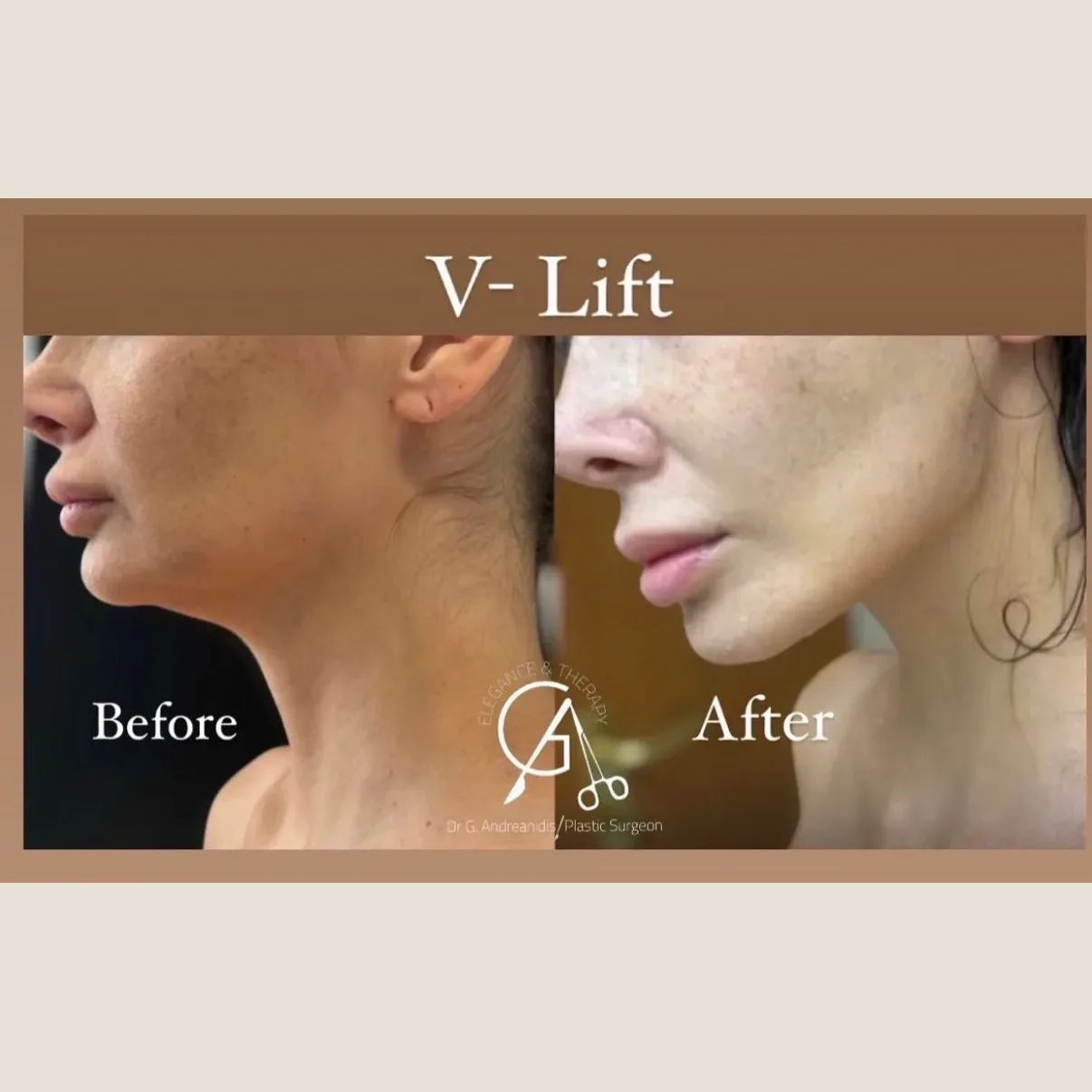VLift-BA02